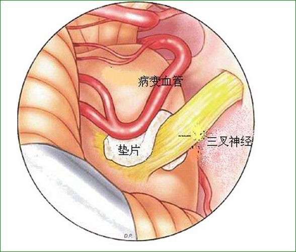 三叉神經(jīng)痛